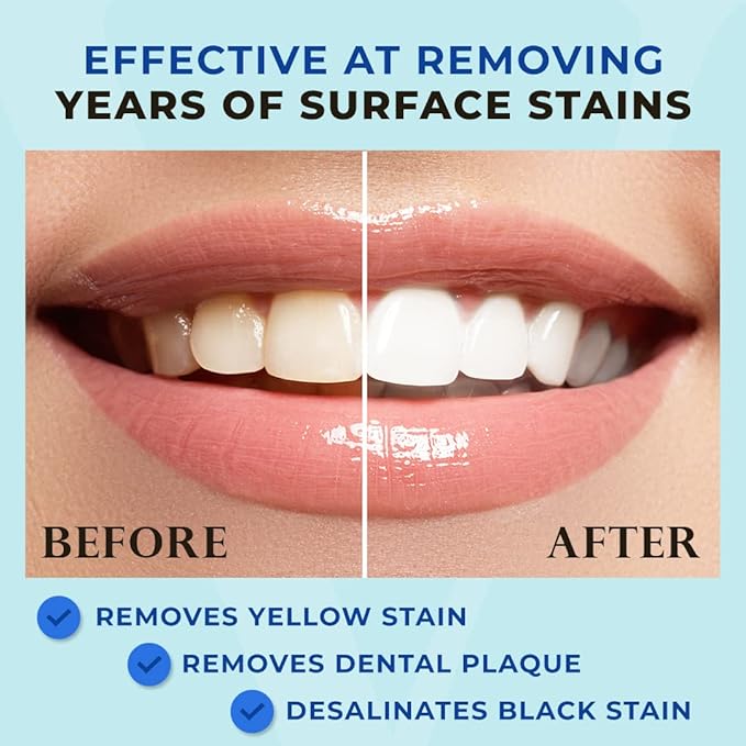 Venus Visage Award Winning Teeth Whitening Pen, 20+ Uses - Teeth whitening Kit Professionally formulated - Best Teeth whitening Gel Pen Teeth Whitener - Low Sensitivity (Mint) (0.07 Fl Oz (Pack of 2))