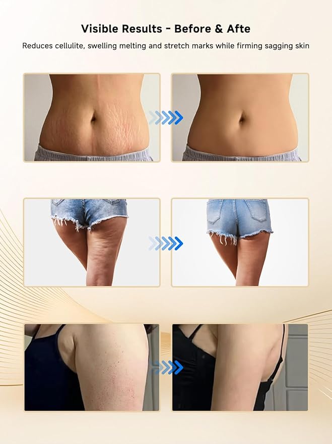 Lymphatic Drainage Massager, Electric Anti Cellulite Massage Tool, Helps Reduce Stretch Marks & Cellulite for Legs & Arms & Belly, Body Sculpting Machine with Microcurrent, Light, Heat & Vibration