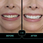 Prostrips - 12 Shades Whiter Teeth - 28 Enamel Safe REMINERALIZING Gentle Strips – 97% no Sensitivity