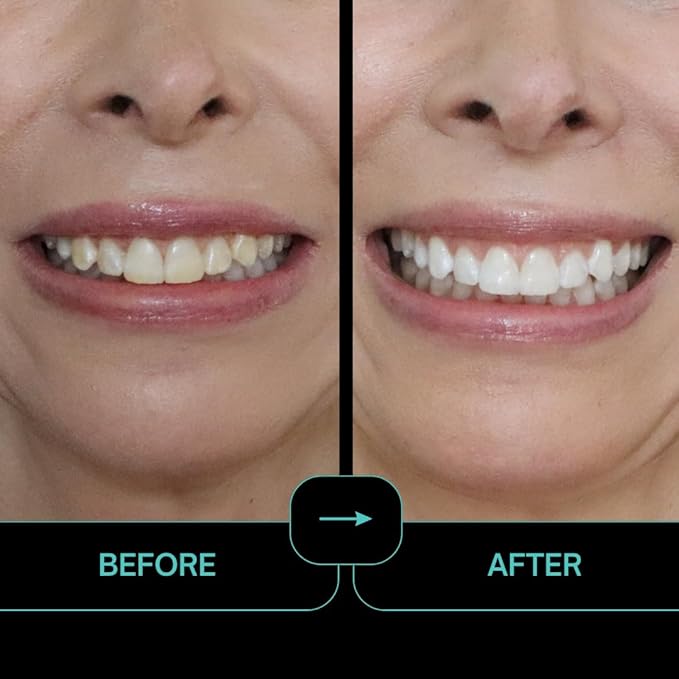 Prostrips - 12 Shades Whiter Teeth - 28 Enamel Safe REMINERALIZING Gentle Strips – 97% no Sensitivity