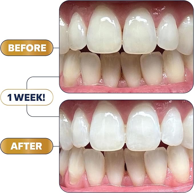 Lumineux Ultimate Whitening Kit Bundle - Contains Toothpaste, Mouthwash, Strips and Whitening Pen - Enamel Safe and Clinically Proven to Whiten Without The Sensitivity - Removes Coffee and Tea Stains