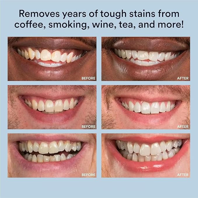 WHITE SMILE Teeth Whitening Kit, LED Light System, 35% Carbamide Peroxide 3 Gel Syringes, 10-Minute Treatment, Non-Sensitive Formula