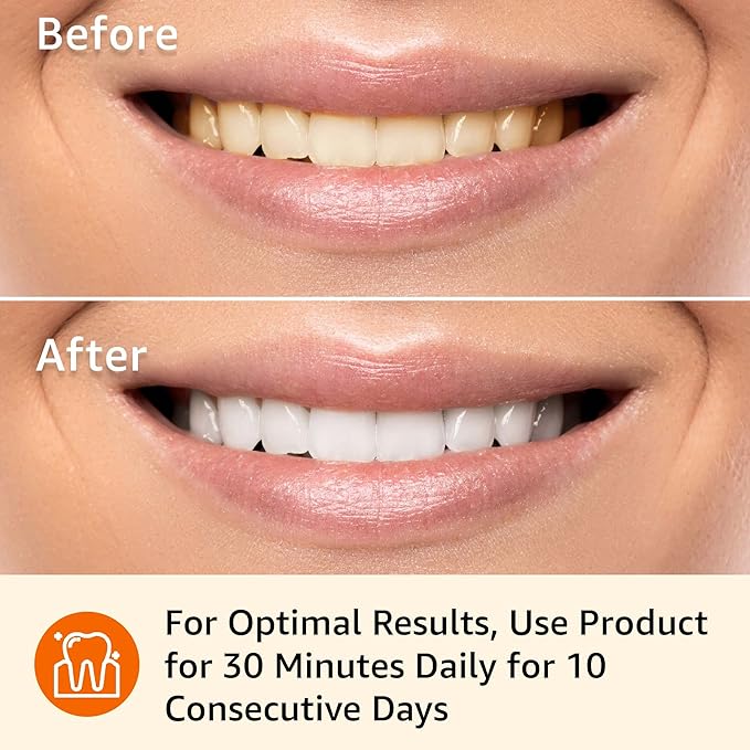 Amazon Basics 10 Day Teeth Whitening Strips Kit, 10 Treatments, 1-Pack (Previously Solimo)