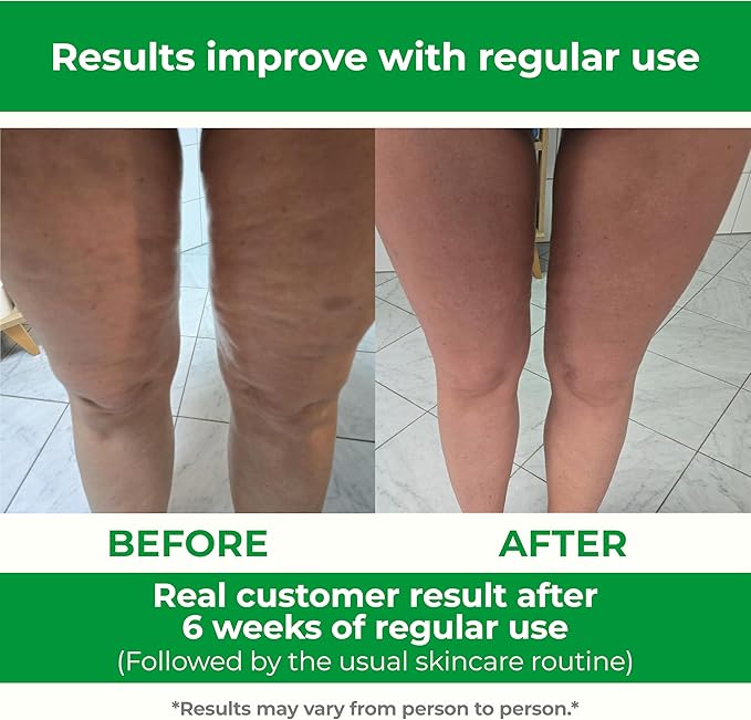 TESMED Cellulite Manual Massager : Made in Italy, Patented with Converging & Diverging Roller Technology. Anti Cellulite Roller for Thighs and Buttock