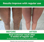 TESMED Cellulite Manual Massager : Made in Italy, Patented with Converging & Diverging Roller Technology. Anti Cellulite Roller for Thighs and Buttock
